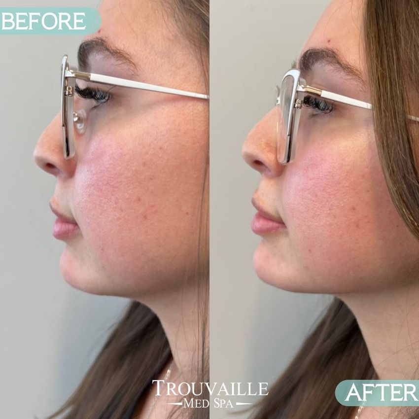 Dermal Fillers before & after